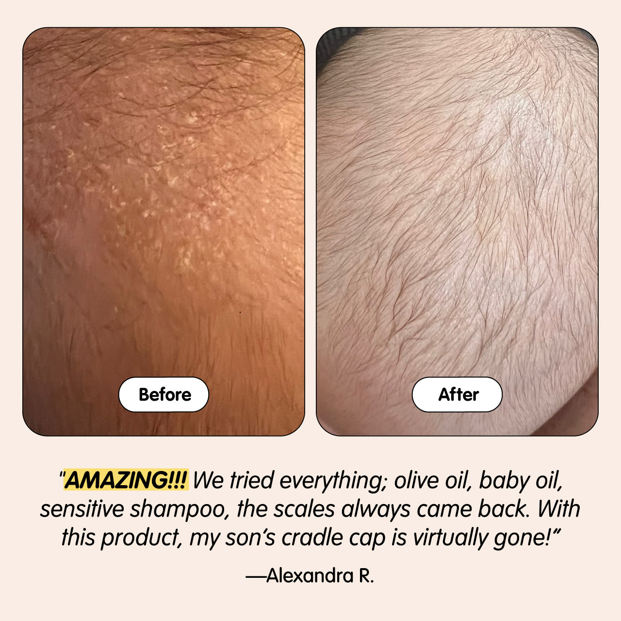 Before and after comparison of cradle cap with text and a quote from Alexandra R.